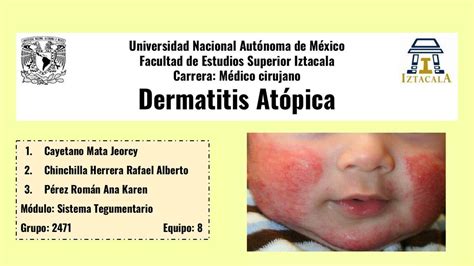 Dermatitis At Pica Ang Lica Mena Udocz