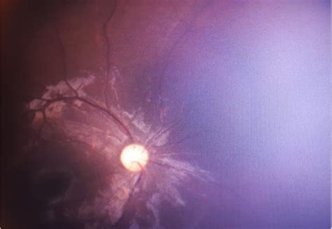 Normal Fundus Of The Right Eye Download Scientific Diagram