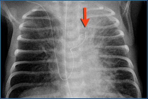 The Radiology Assistant Lines And Tubes In Neonates