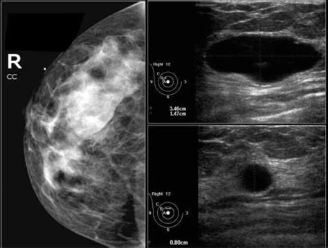 The Radiology Assistant Bi Rads For Mammography And Ultrasound