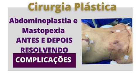 Erros De Abdominoplastia Fotos BRAINCP