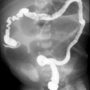 ileal atresia pediatric radiology reference article pediatric