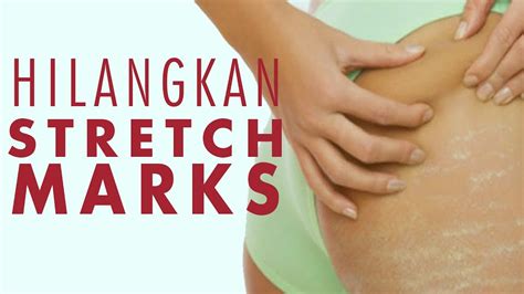 Cara Nak Menghilangkan Stretch Mark