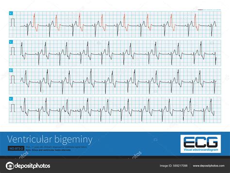 Year Old Male Clinically Diagnosed Ventricular Septal Defect His Ecg