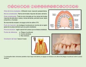 Bloqueo Epidural Info Avance La Aguja Varios Mil Metros