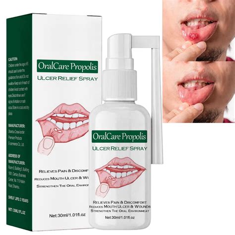 Mouth Ulcer Treatment Spray Effective Mouth Ulcer Spray Ulcer Treatment Tongue Oralcare Propolis