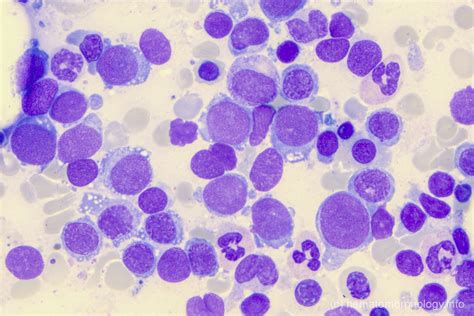 Aml Erythroid Leukemia Hematomorphology A Databank Imagebank For