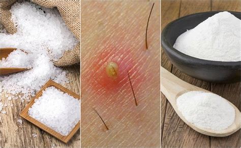 5 Soluciones Naturales Para Quitar Los Vellos Encarnados Mejor Con Salud