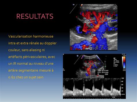 Deroulement Echo Doppler Des Arteres Renales