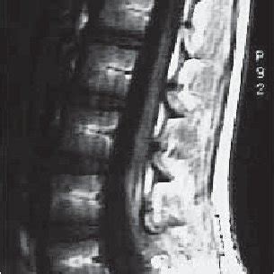 MRI of tethered cord in one of the studied patients | Download ...