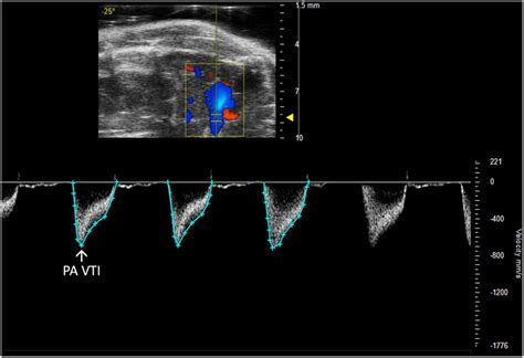 Pulmonary Artery Velocity Time Integral Pa Vti Directly Measures