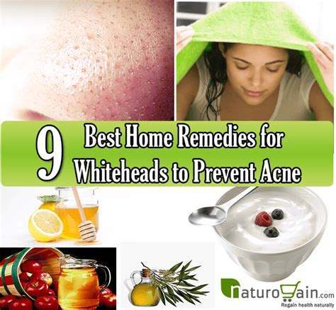 9 Best Home Remedies for Whiteheads to Prevent Acne