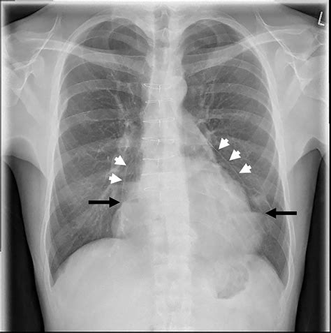 Myocardial Biopsy Techniques And Indications Heart