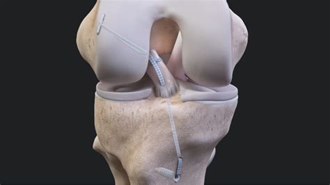 ACL Repair Arthrex Knee Preservation