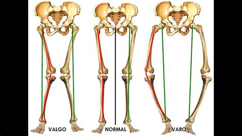 Rodillas Genu Varo Terapia En Casa Youtube