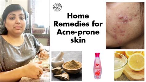 Remedies For Acne Prone Skin