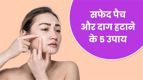 चेहरे पर सफेद दाग और पैच मिटाएंगे ये 5 घरेलू उपाय White Spots And