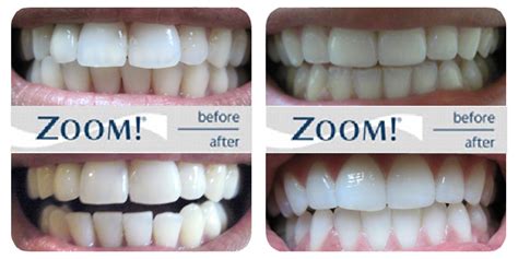 Before and after zoom whitening - fairyasl