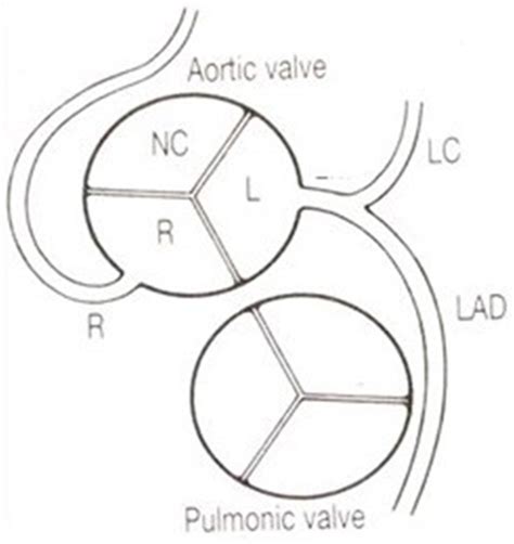 The coronary arteries arise from the facing aortic sinuses ...