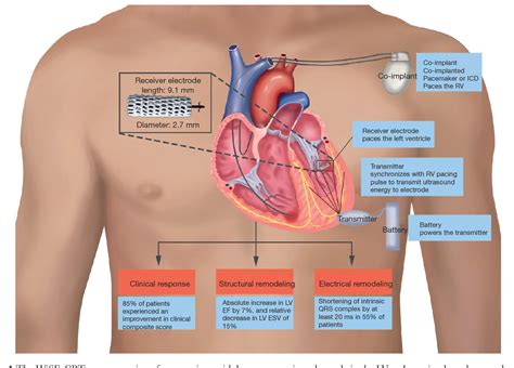 Figure From Cardiac Resynchronization Therapy With Wireless Left