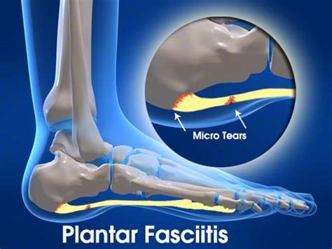 Plantar Fasciitis Orthopedic Regenerative Medicine Center Of Santa Rosa