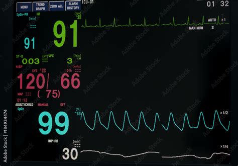 Ekg Monitor