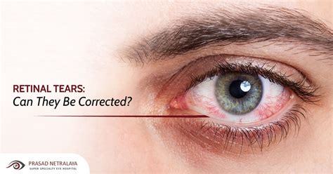 What Causes A Retinal Tear In The Eye - Infoupdate.org