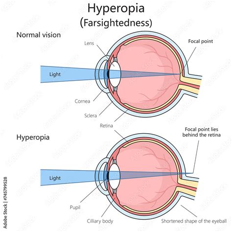 Farsightedness Hypermetropia Hyperopia Structure Diagram Hand Drawn Schematic Raster