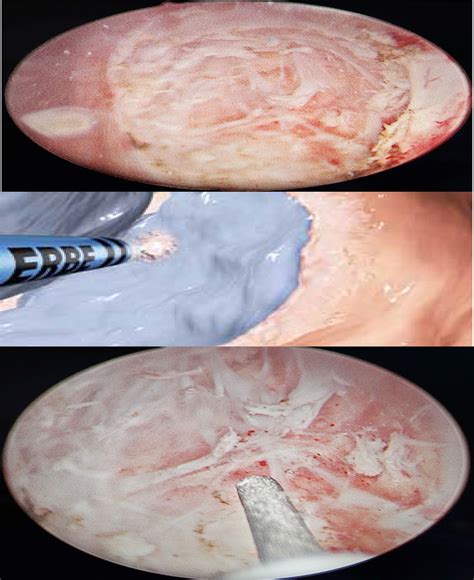 Técnica quirúrgica de la resección transuretral de tumor vesical en