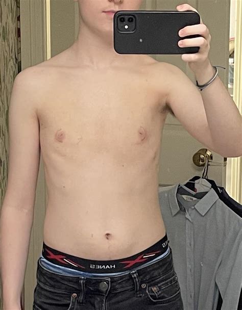 1 Month Post Op Dr Medalie R Top Surgery Peri