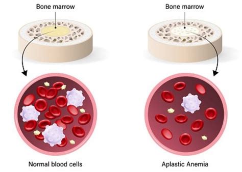 Fakta Fakta Anemia Aplastik Penyakit Langka Yang Diderita Babe Cabita
