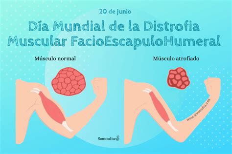 Dia Mundial De La Distrofia Muscular La Discapacidad En Acci N The