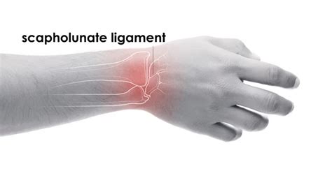 Scapholunate Ligament Tear - Torn Ligament in the Wrist | TorkLaw