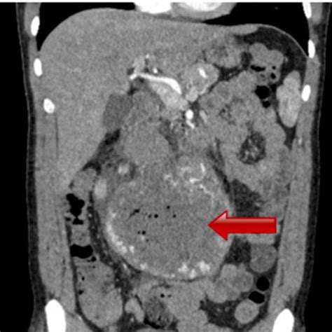 Abdominal Computed Tomography Showing A Large Heterogeneously Enhancing