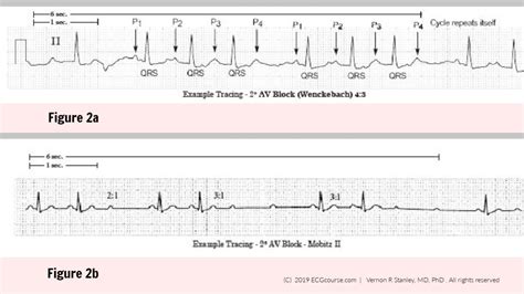 ECG Rhythms: Is this Rhythm Second Degree AV Block 2:1 Mobitz 1 (I) or ...