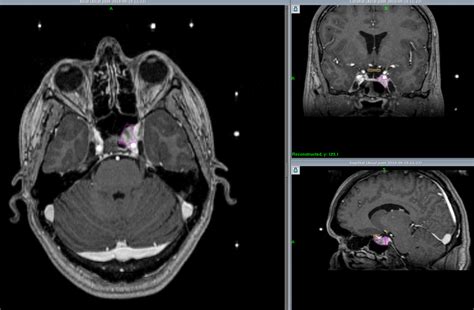 Condition - Pituitary Adenoma