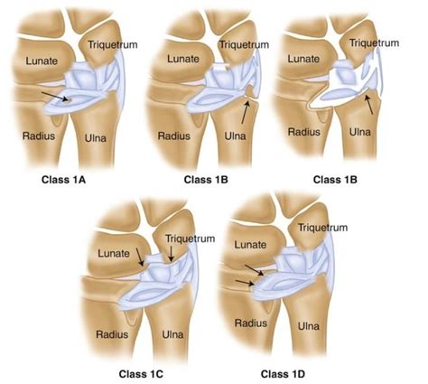 Fovea Sign Triangular Fibrocartilage Complex TFCC Exam