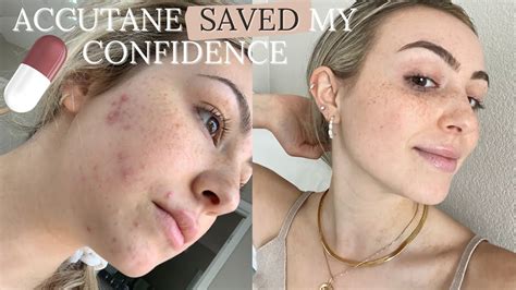 Filming My Accutane Journey Youtube