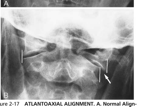 Spine Pathology Flashcards Quizlet