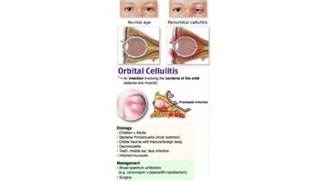 Preseptal Cellulitis Vs Orbital Cellulitis