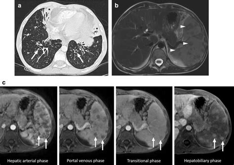 Mycobacterium avium-intracellulare infection: 17-year-old male patient ...