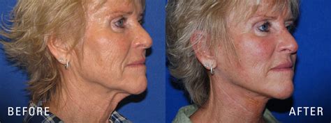 Facelift Before After Photos Illume Cosmetic Surgery Medspa