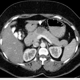 Contrast Enhanced Ct Abdomen Image In Portal Venous Phase Showing A