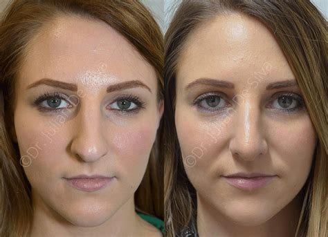 Rhinoplasty Revealed The Secrets To A Perfectly Proportioned Nose