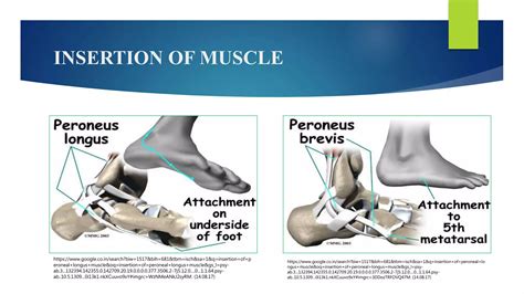 Peroneal Tendinopathy Ppt