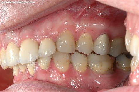 Orthodontic Corner Class Ii Div 2 Deep Bite Where Is The Limit