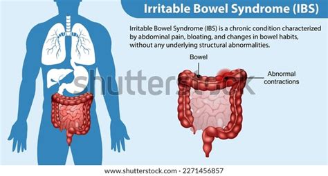 Irritable Bowel Syndrome Ibs Infographic Illustration Stock Vector Royalty Free 2271456857