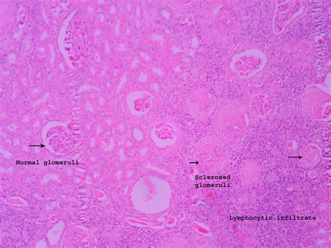 Chronic pyelonephritis – Histopathology.guru