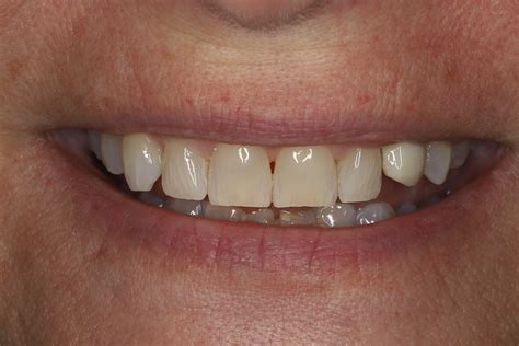 Teeth Deep Cleaning Before And After