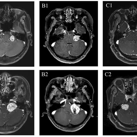 T Contrast Enhanced Mri Of Patients With Preoperative Gamma Knife